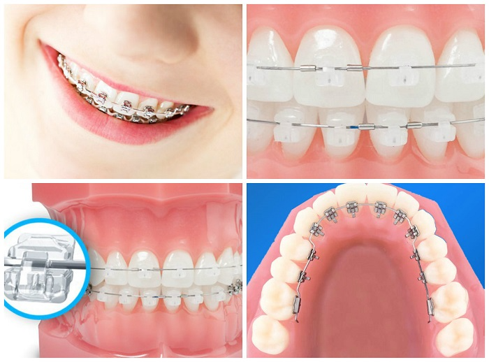 Quá trình niềng răng không thể thiếu sự hỗ trợ của các loại khí cụ chuyên dụng