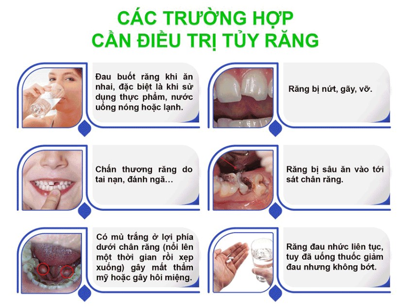 Các trường hợp cần điều trị tủy răng