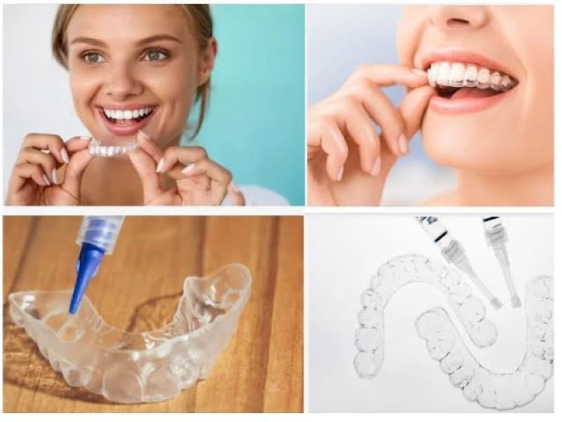 tẩy trắng răng tại nhà Opalescence 2