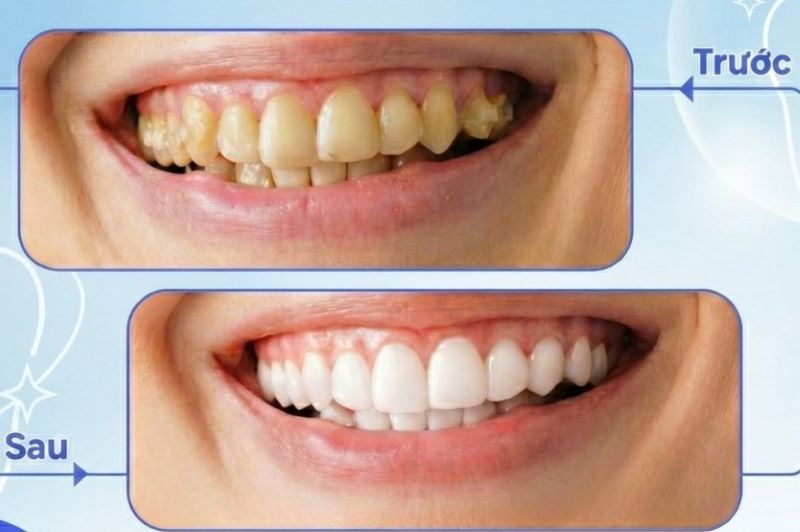Hiệu quả tẩy trắng răng rõ rệt khi chọn gel Opalescence